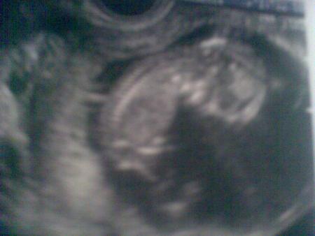 Ma premiere echo - 31/07/2008